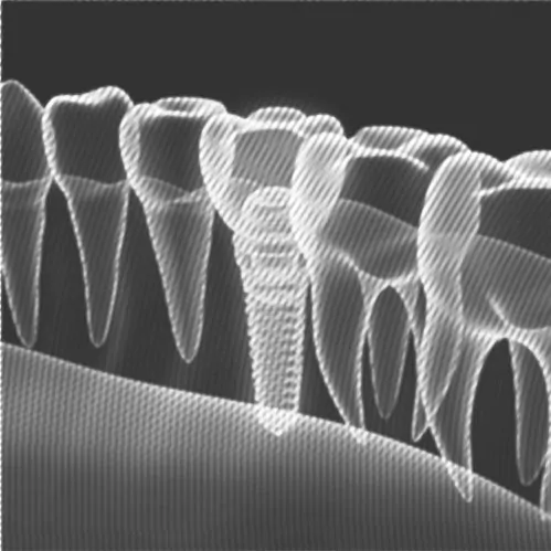 schematische Darstellung einer zahnreihe, ein fehlender zahn ist durch ein Implantat plus Krone versorgt