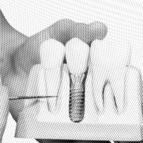 Modell eines Kiefers mit Implantat, Thema: Knochenaufbau
